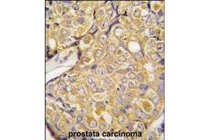 Formalin-fixed and paraffin-embedded human prostata carcinoma tissue reacted with , which was peroxidase-conjugated to the secondary antibody, followed by DAB staining. (TRPM8 antibody  (AA 521-552))