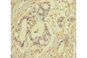 Immunohistochemistry of paraffin-embedded human pancreatic cancer using ABIN7170681 at dilution of 1:100 (SRPK3 antibody  (AA 1-300))