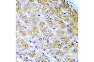 Immunohistochemistry of paraffin-embedded human liver cancer using BMF antibody at dilution of 1:200 (40x lens). (BMF antibody)