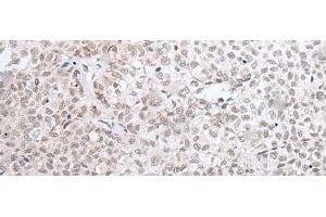 Immunohistochemistry of paraffin-embedded Human ovarian cancer tissue using HOXC11 Polyclonal Antibody at dilution of 1:25(x200) (HOXC11 antibody)