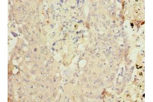 Immunohistochemistry of paraffin-embedded human lung cancer using ABIN7149271 at dilution of 1:100 (CYP4B1 antibody  (AA 30-250))