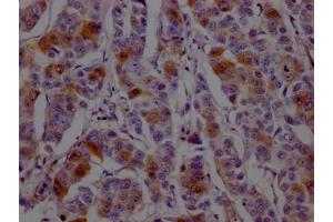 IHC image of ABIN7127454 diluted at 1:100 and staining in paraffin-embedded human breast cancer performed on a Leica BondTM system. (Recombinant Dihydrofolate Reductase antibody)