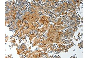 The image on the left is immunohistochemistry of paraffin-embedded Human tonsil tissue using ABIN7130695(PRCP Antibody) at dilution 1/20, on the right is treated with fusion protein.