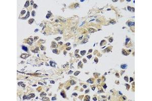 Immunohistochemistry of paraffin-embedded Human lung cancer using C12orf10 Polyclonal Antibody at dilution of 1:100 (40x lens).