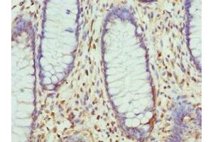 Immunohistochemistry of paraffin-embedded human colon cancer using ABIN7158341 at dilution of 1:100 (LIMS1 antibody  (AA 1-325))