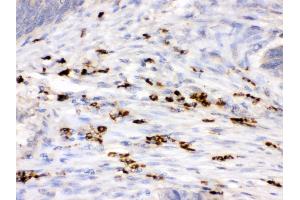 Anti- Lysozyme Picoband antibody, IHC(P) IHC(P): Human Intestinal Cancer Tissue (LYZ antibody  (C-Term))