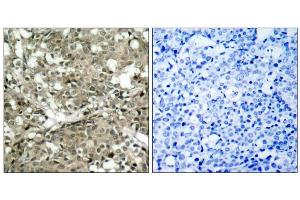 Immunohistochemical analysis of paraffin-embedded human breast carcinoma tissue using c-Abl (Ab-412) antibody (E021156). (ABL1 antibody)