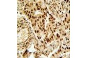 Immunohistochemistry analysis in formalin fixed and paraffin embedded human lung carcinoma reacted with HDAC2 Antibody (Center) followed which was  peroxidase conjugated to the secondary antibody and followed by DAB staining.