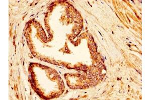 IHC image of ABIN7143895 diluted at 1:300 and staining in paraffin-embedded human prostate cancer performed on a Leica BondTM system. (IDUA antibody  (AA 28-653))