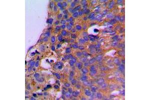 Immunohistochemical analysis of CEP41 staining in human breast cancer formalin fixed paraffin embedded tissue section. (CEP41 antibody  (Center))