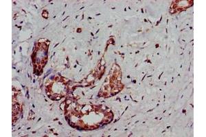 Immunohistochemistry of paraffin-embedded human breast cancer using ABIN7169039 at dilution of 1:100 (DCLK1 antibody  (AA 143-381))