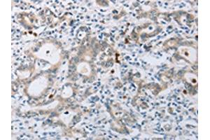 The image on the left is immunohistochemistry of paraffin-embedded Human gastic cancer tissue using ABIN7189583(ABCB9 Antibody) at dilution 1/15, on the right is treated with synthetic peptide. (ABCB9 antibody)