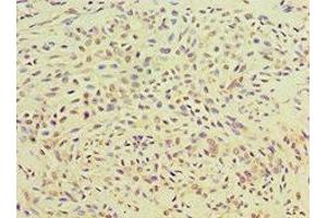 Immunohistochemistry of paraffin-embedded human breast cancer using ABIN7166414 at dilution of 1:100 (Transglutaminase 2 antibody  (AA 438-687))