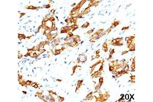 IHC testing of breast carcinoma (20X) stained with HSP27 antibody (G3.