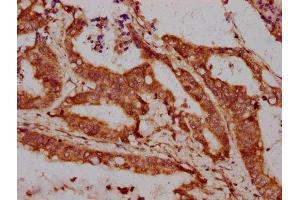 IHC image of ABIN7157828 diluted at 1:300 and staining in paraffin-embedded human colon cancer performed on a Leica BondTM system. (LPO (AA 81-190) antibody)