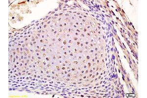 Formalin-fixed and paraffin embedded humanlung carcinoma labeled with Rabbit Anti Lamin B Receptor Polyclonal Antibody, Unconjugated (ABIN709391) at 1:200 followed by conjugation to the secondary antibody and DAB staining (Lamin B Receptor antibody  (AA 1-100))