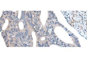 Immunohistochemistry of paraffin-embedded Human colorectal cancer tissue using UBR4 Polyclonal Antibody at dilution of 1:55(x200) (UBR4 antibody)