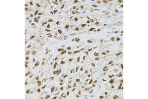 Immunohistochemistry of paraffin-embedded human lung cancer using TGM2 antibody. (Transglutaminase 2 antibody)