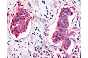 Anti-ELTD1 antibody IHC of human Breast, Carcinoma. (ELTD1 antibody  (C-Term))