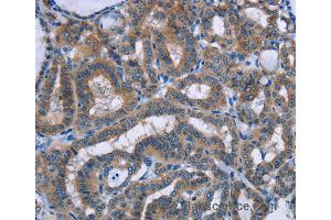 Immunohistochemistry of Human colon cancer using PLIN1 Polyclonal Antibody at dilution of 1:30