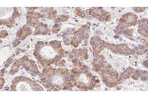 ABIN6272681 at 1/100 staining Human liver cancer tissue by IHC-P. (CCR4 antibody  (N-Term))