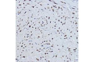 Immunohistochemistry of paraffin-embedded human uterus using ESRRA antibody (ABIN6129375, ABIN6140306, ABIN6140307 and ABIN6218463) at dilution of 1:200 (40x lens).