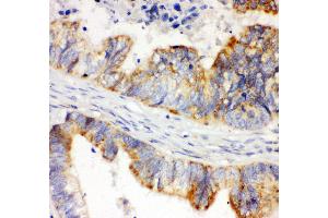 Immunohistochemistry (IHC) image for anti-Hypoxia Inducible Factor 1, alpha Subunit (Basic Helix-Loop-Helix Transcription Factor) (HIF1A) (AA 703-732), (C-Term) antibody (ABIN3043841)