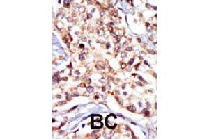 Formalin-fixed and paraffin-embedded human cancer tissue reacted with SRC polyclonal antibody  , which was peroxidase-conjugated to the secondary antibody, followed by DAB staining. (Src antibody  (N-Term))