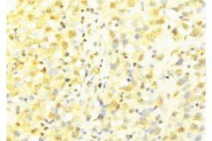 ABIN6277633 at 1/100 staining Human breast cancer tissue by IHC-P. (HAX1 antibody  (C-Term))
