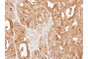 IHC-P Image Immunohistochemical analysis of paraffin-embedded N87 xenograft, using SLC25A13, antibody at 1:500 dilution.