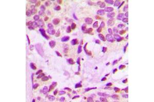 Immunohistochemical analysis of IRX3 staining in human breast cancer formalin fixed paraffin embedded tissue section.