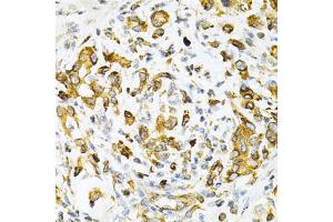 Immunohistochemistry of paraffin-embedded human gastric cancer using TAPBP Antibody. (TAPBP antibody)