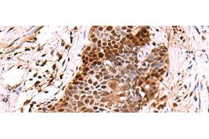 Immunohistochemistry of paraffin-embedded Human esophagus cancer tissue using POLD2 Polyclonal Antibody at dilution of 1:60(x200) (POLD2 antibody)