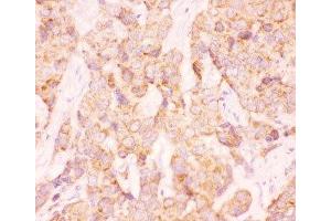 IHC-P: AAMP antibody testing of human breast cancer tissue
