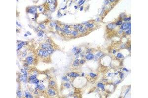 Immunohistochemistry of paraffin-embedded Human liver cancer using PNLIP Polyclonal Antibody at dilution of 1:100 (40x lens). (PNLIP antibody)