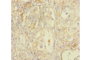 Immunohistochemistry of paraffin-embedded human lung cancer using ABIN7170802 at dilution of 1:100 (STOML2 antibody  (AA 29-356))