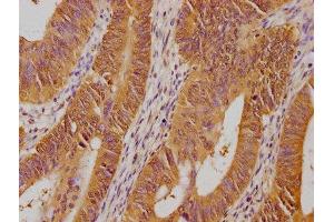 IHC image of ABIN7139700 diluted at 1:100 and staining in paraffin-embedded human colon cancer performed on a Leica BondTM system. (PSMD14 antibody  (Regulatory Subunit 14))