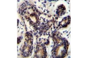 Immunohistochemistry analysis in formalin fixed and paraffin embedded human breast tissue reacted with AP52820PU-N, which was peroxidase conjugated to the secondary antibody and followed by DAB staining.