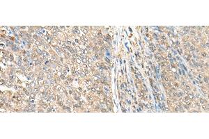 Immunohistochemistry of paraffin-embedded Human liver cancer tissue using ASS1 Polyclonal Antibody at dilution of 1:35(x200) (ASS1 antibody)