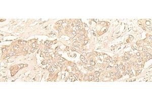 Immunohistochemistry of paraffin-embedded Human liver cancer tissue using DIMT1 Polyclonal Antibody at dilution of 1:30(x200) (DIMT1 antibody)