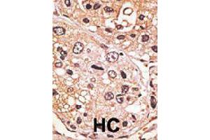 Formalin-fixed and paraffin-embedded human hepatocellular carcinoma tissue reacted with GDF9 polyclonal antibody  , which was peroxidase-conjugated to the secondary antibody, followed by AEC staining.