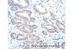 Immunohistochemistry of Human colon cancer using ALDH1A2 Polyclonal Antibody at dilution of 1:60 (ALDH1A2 antibody)