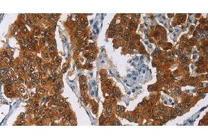 Immunohistochemistry of paraffin-embedded Human breast cancer tissue using CRABP2 Polyclonal Antibody at dilution 1:40 (CRABP2 antibody)