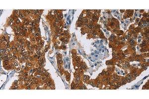 Immunohistochemistry of paraffin-embedded Human breast cancer tissue using CRABP2 Polyclonal Antibody at dilution 1:40 (CRABP2 antibody)