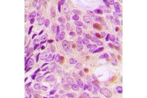 Immunohistochemical analysis of DLGAP5 staining in human breast cancer formalin fixed paraffin embedded tissue section. (DLGAP5 antibody)