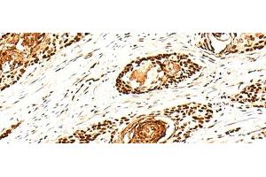 Immunohistochemistry of paraffin-embedded Human esophagus cancer tissue using H1FX Polyclonal Antibody at dilution of 1:30(x200) (H1FX antibody)