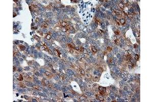 Immunohistochemical staining of paraffin-embedded Adenocarcinoma of colon tissue using anti-SIL1 mouse monoclonal antibody.
