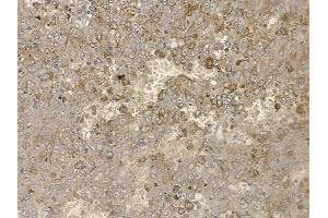 ABIN6255046 and ABIN6267160 at 1/100 staining human melanoma by IHC-P. (PRAS40 antibody  (pSer183))