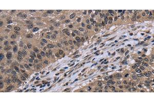 Immunohistochemistry of paraffin-embedded Human lung cancer using ITGAE Polyclonal Antibody at dilution of 1:60