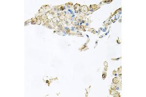 Immunohistochemistry of paraffin-embedded human lung injury using AIF1 antibody (ABIN5970719) at dilution of 1/100 (40x lens). (Iba1 antibody)